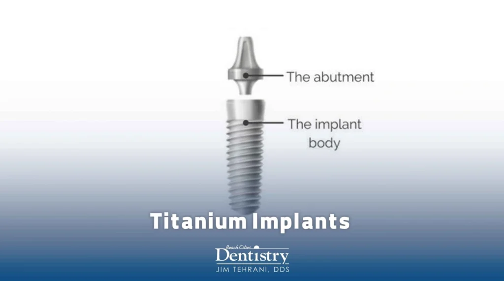 Diagram of a titanium dental implant showing the abutment and implant body parts by Beach Cities Dentistry